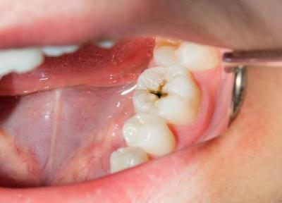 آشنایی با انواع پوسیدگی در دندان آشنا